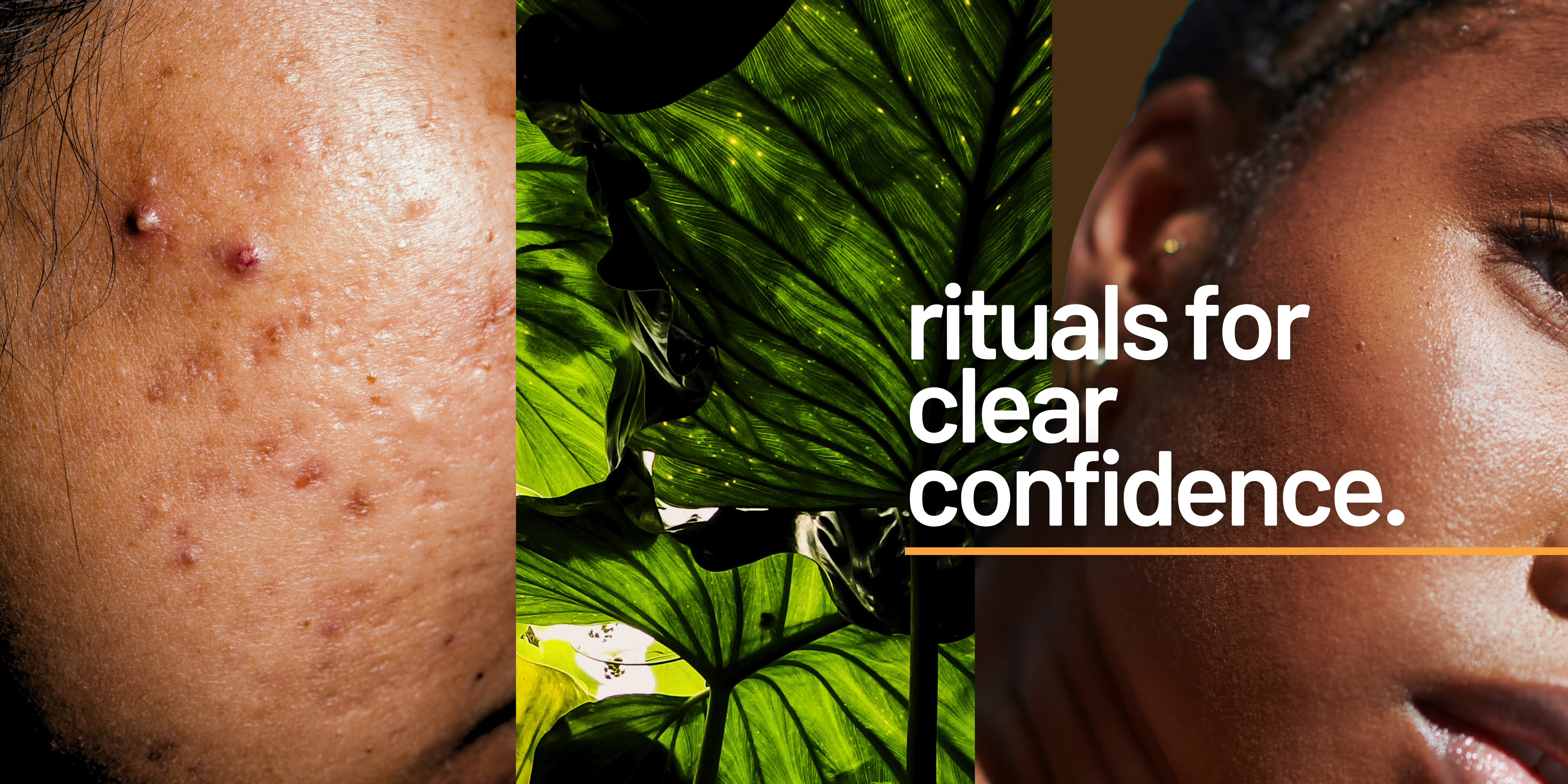 Acne + Blemishes